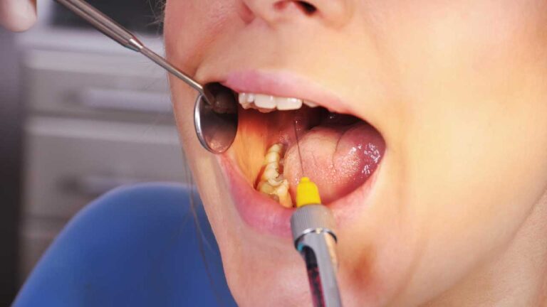 Exploration of Dental Abscesses and Their Management