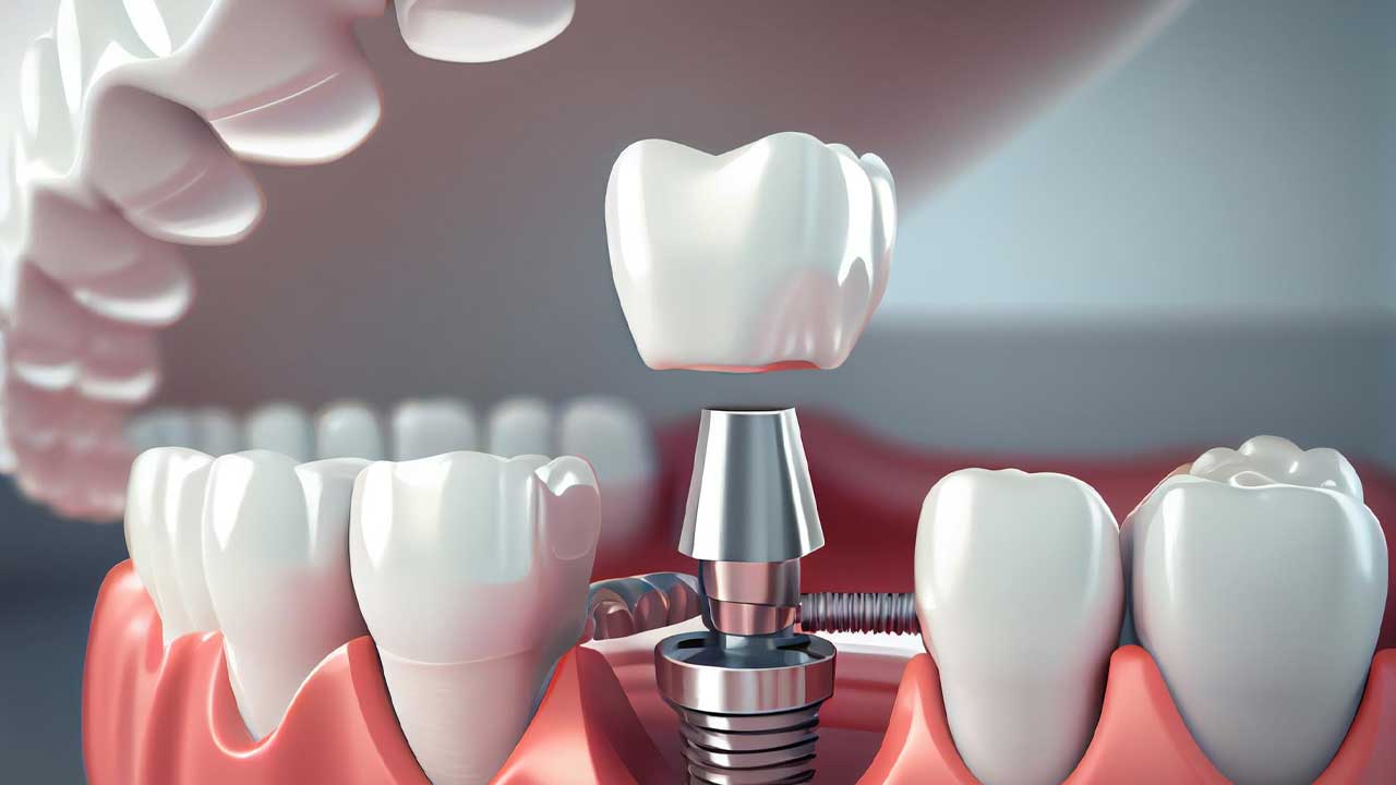 How Do Dental Implants Work?