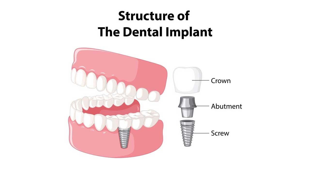 How Do Dental Implants Work? - Dental Health