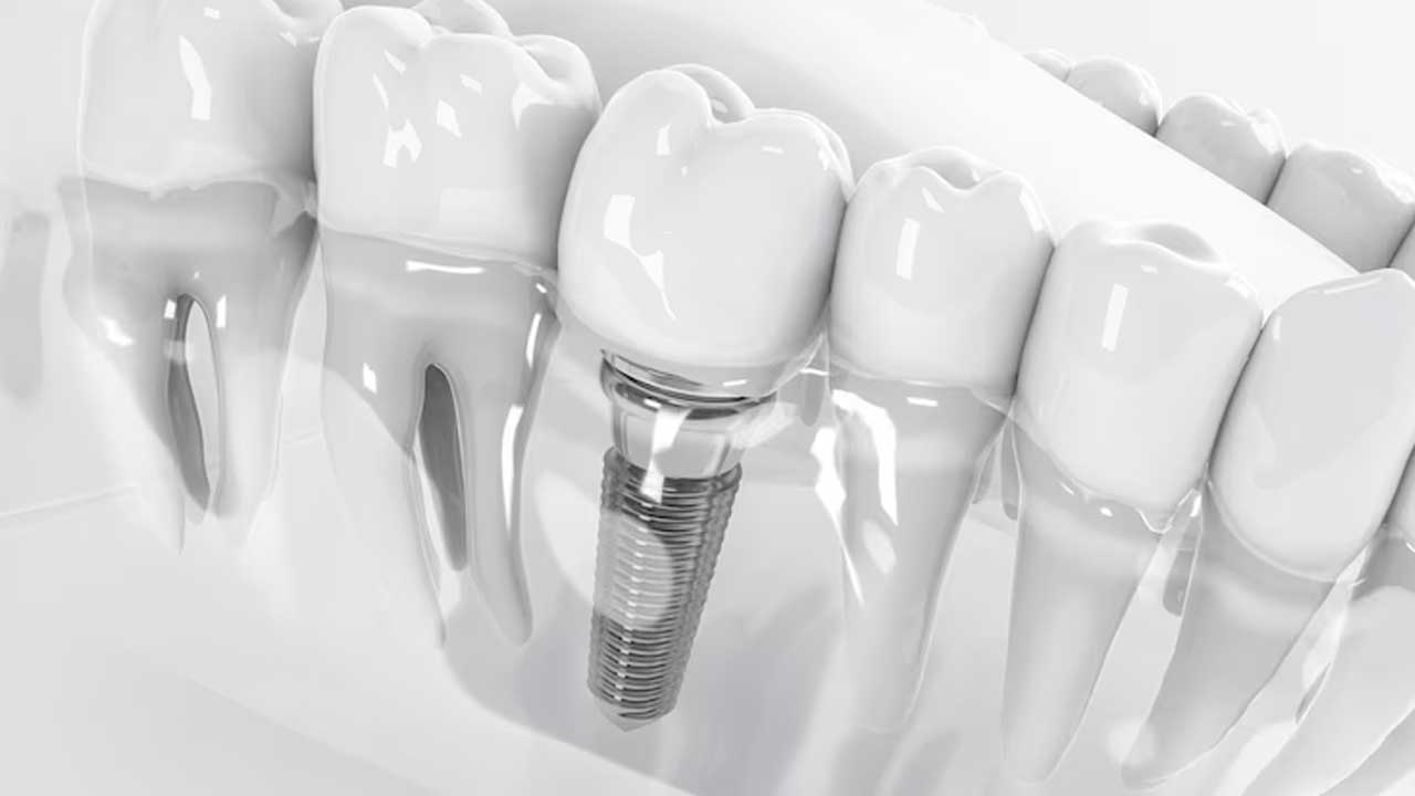 How Long Do Dental Implants Last?