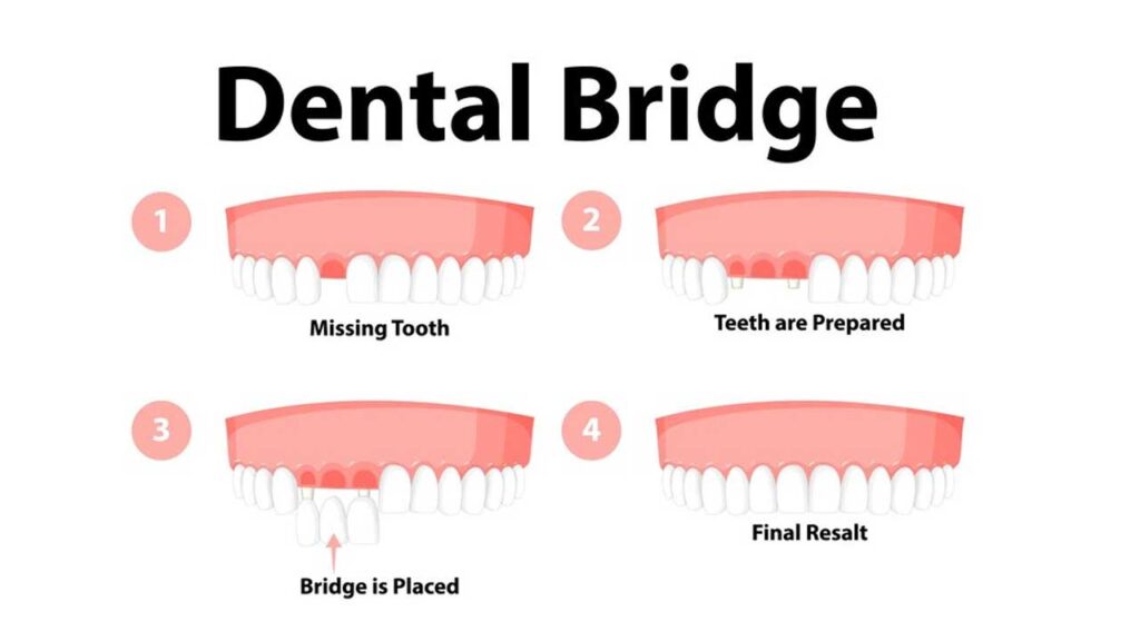 what does a dental bridge look like