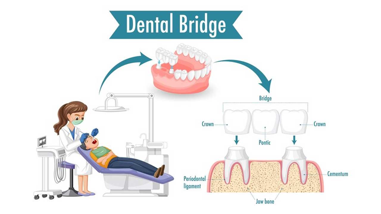 The Lifespan of Dental Bridges: What to Expect