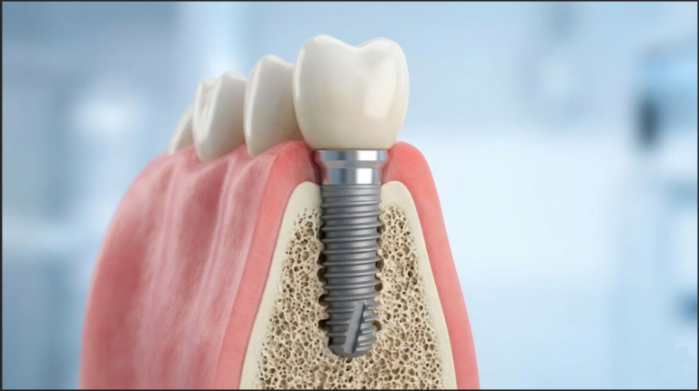 A dental implant is shown inserted into gum tissue, revealing surrounding bone structure and a crown on top.